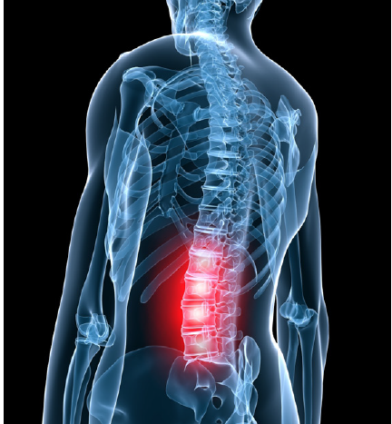 Reversal of Cervical Lordosis